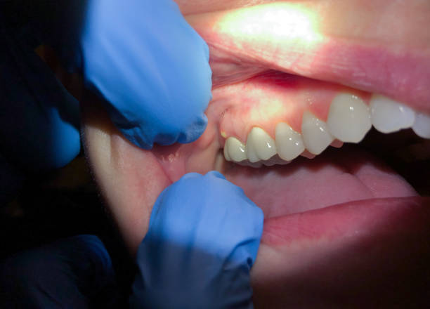 Best Emergency Gum Treatment in Eufaula, OK