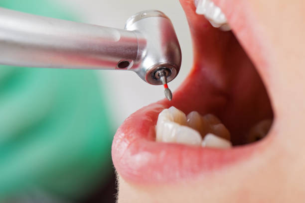 Best Emergency Treatment for Dental Infections or Abscesses in Eufaula, OK